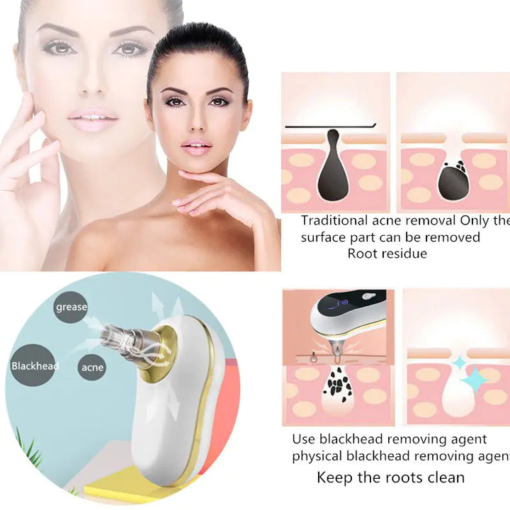 Blackhead Remover